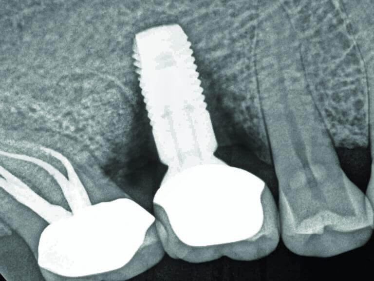 Vnetje v kosti ob vsadku