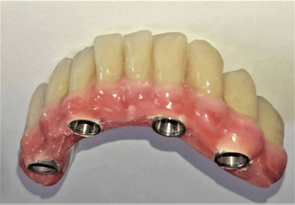all on 4 zobna proteza na implantatih