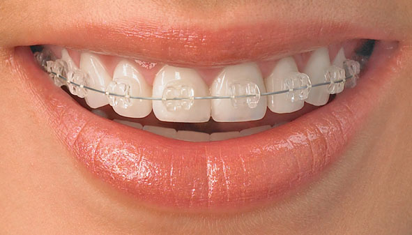 Beli zobni nosilci