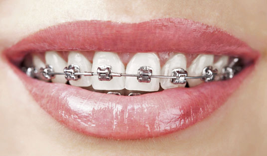 Kovinski zobni nosilci