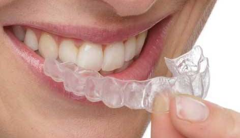 Aligner (Invisalign)