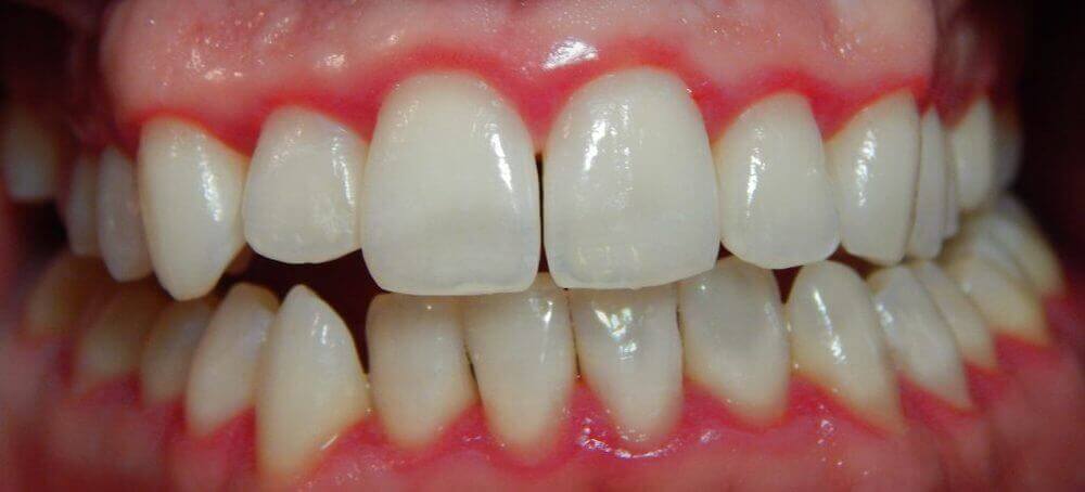 Vnetje dlesni ali gingivitis