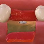 Vstavitev zobnega vsadka