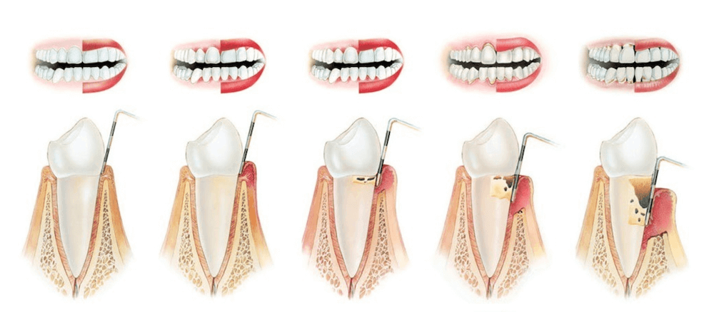 Prikaz razvoja parodontalne bolezni