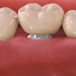 Zobna krona na vsadku