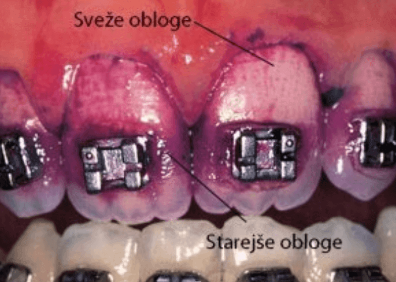 Zobne obloge ob ortodontskem aparatu