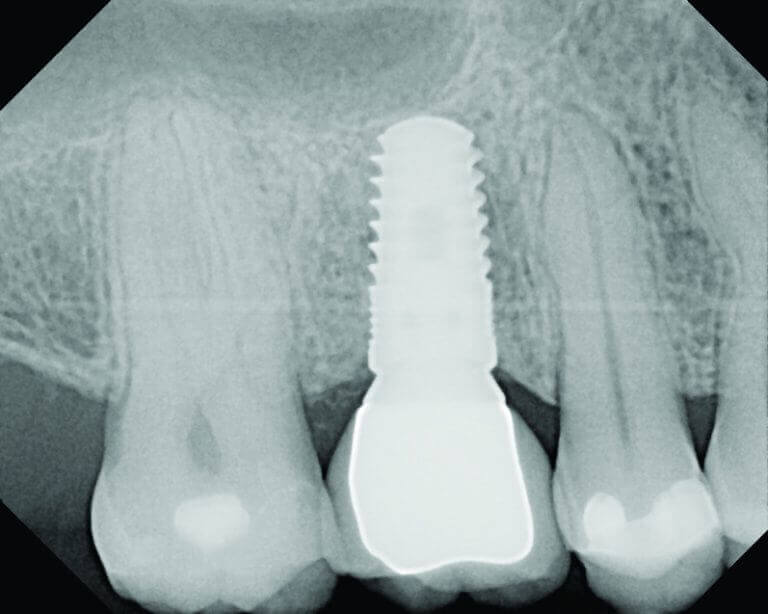 Zobni vsadek z zdravo okoliško kostjo