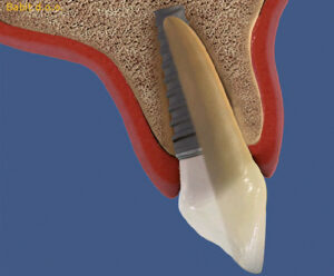 Implantat zob