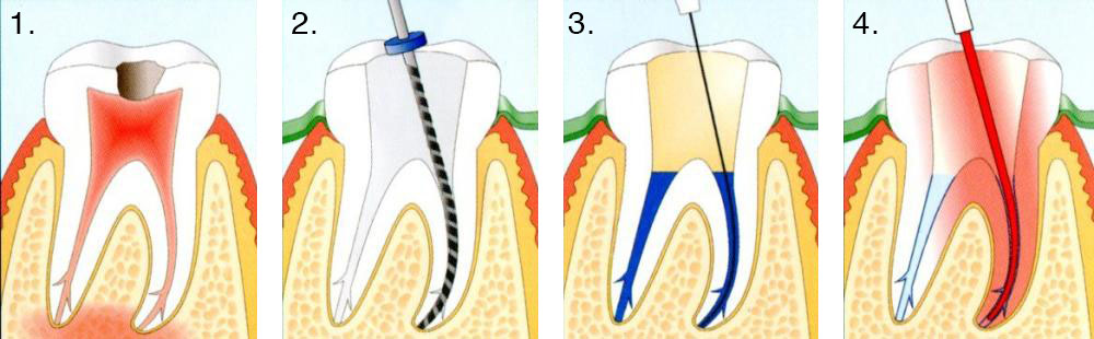 Endodontsko zdravljenje